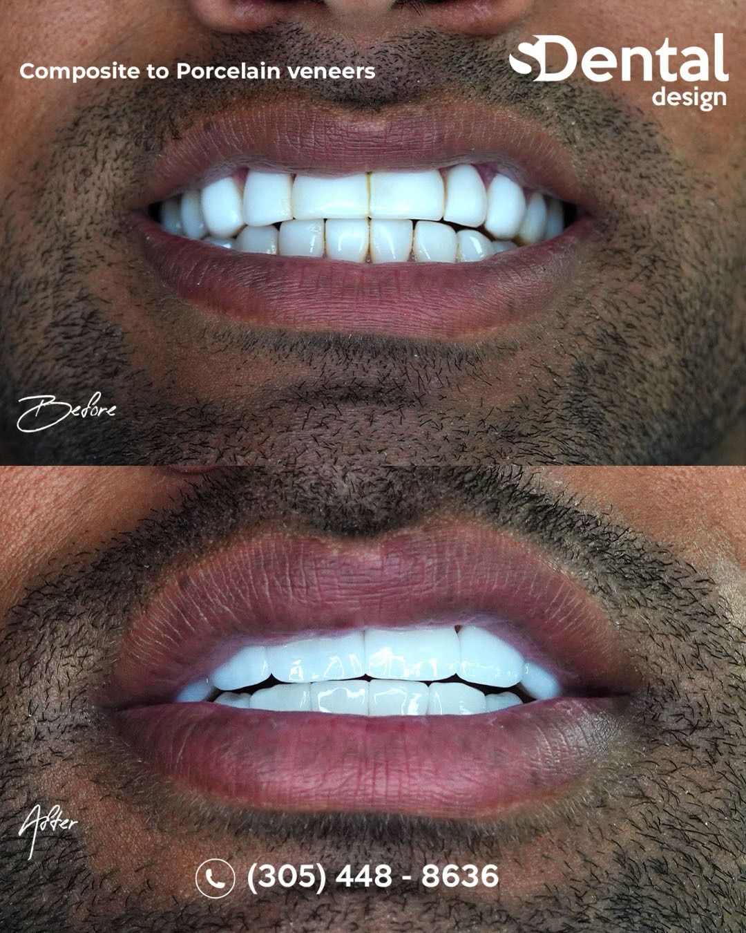 Porcelain Veneers