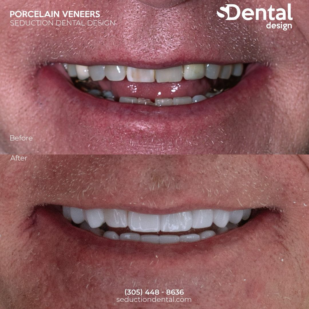 Porcelain Veneers