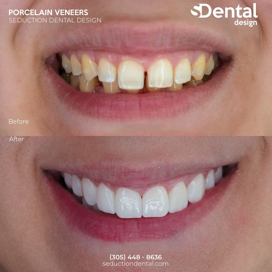 Porcelain Veneers