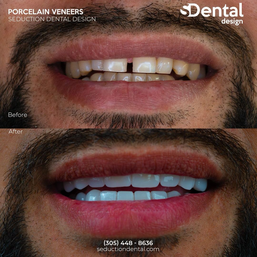 Porcelain Veneers