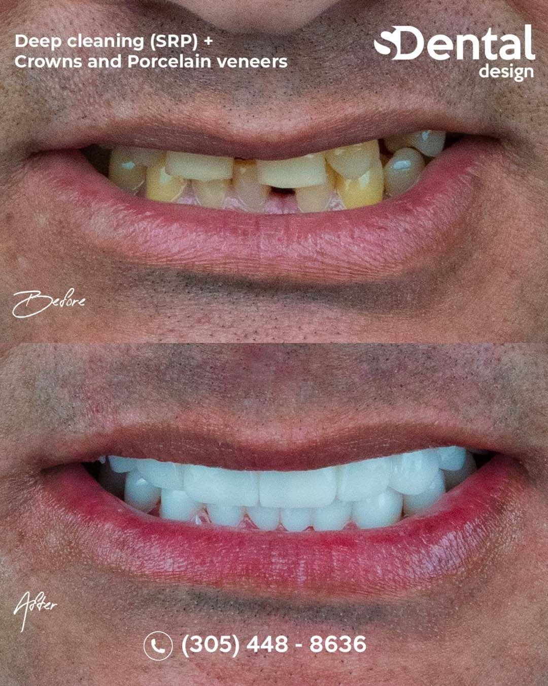 Porcelain veneers close-up — natural translucency and finish, Svelta Dental Design