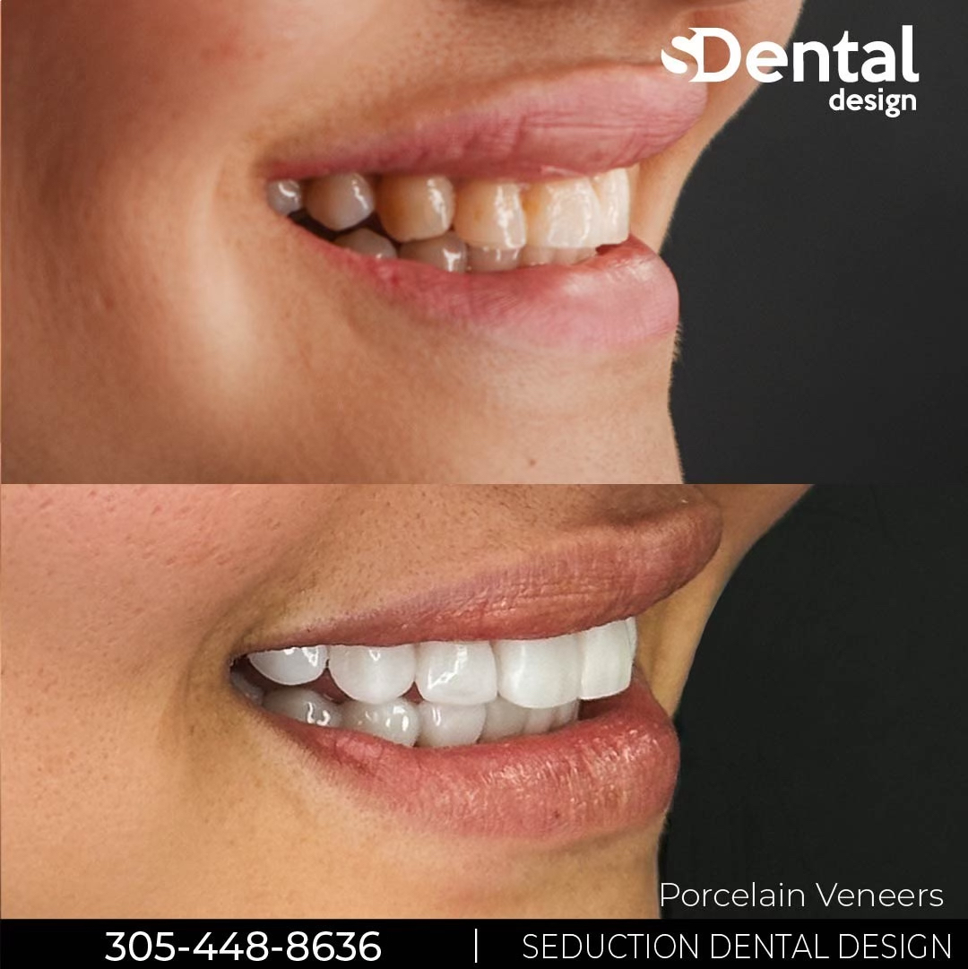 Porcelain Veneers