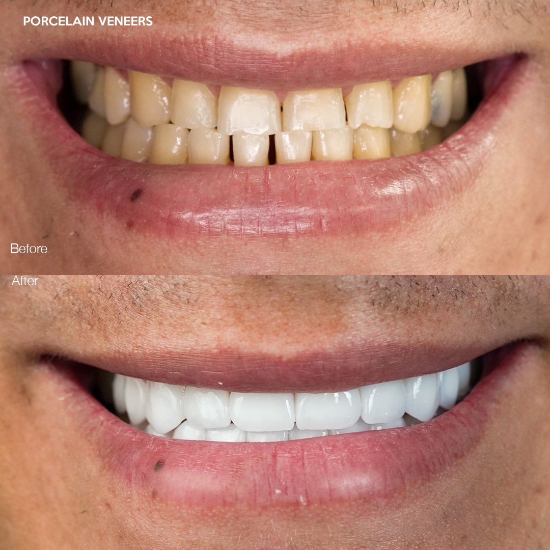 Case 526, porcelain veneers before and after, Svelta Dental Design Miami
