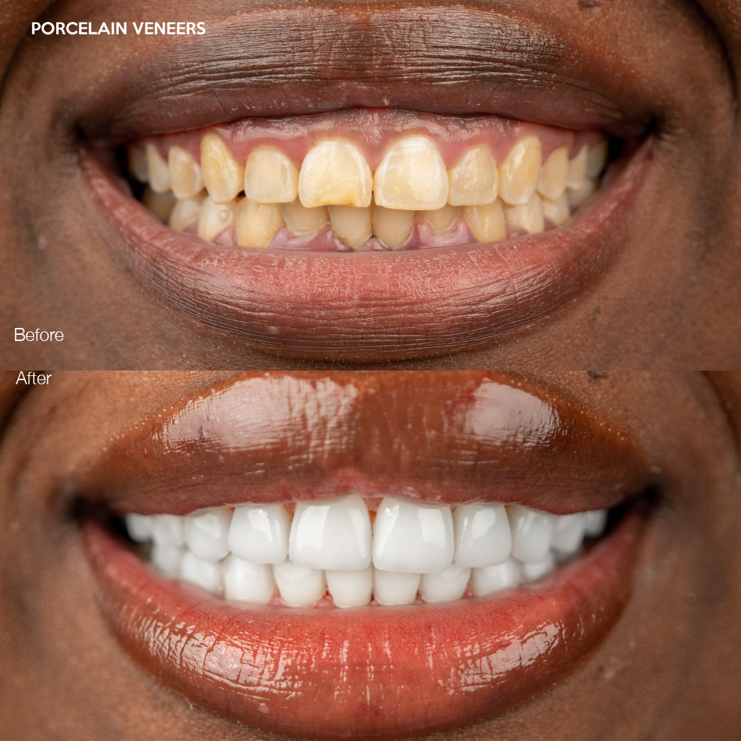 Case 555, porcelain veneers before and after, Svelta Dental Miami