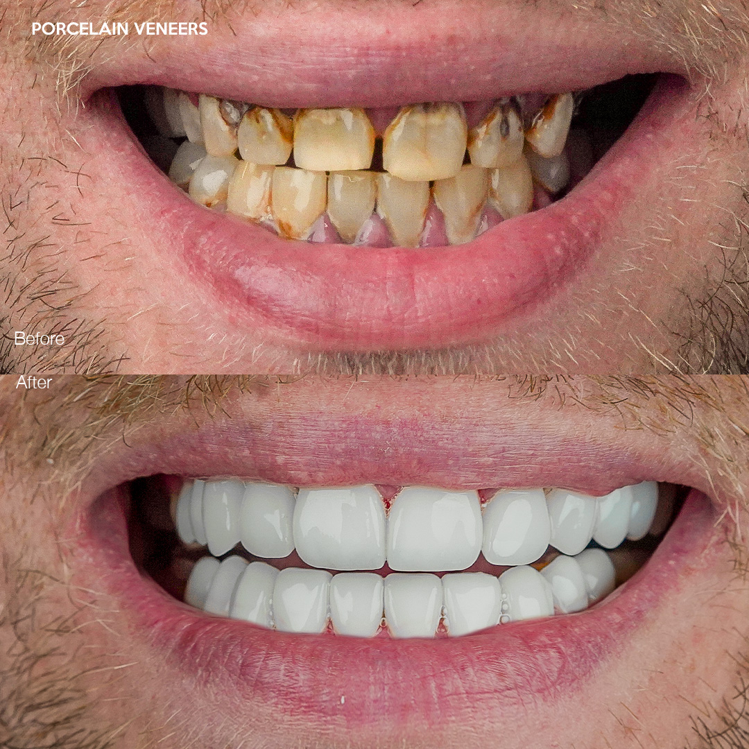 Case 580, porcelain veneers before and after Miami