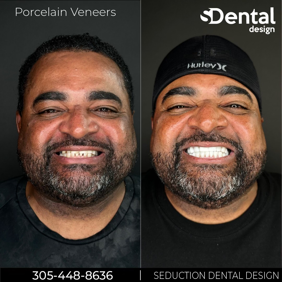 Porcelain Veneers