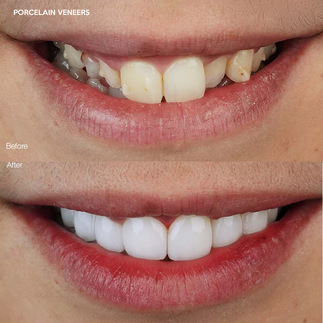 Porcelain veneers smile transformation, Svelta Dental Design Miami