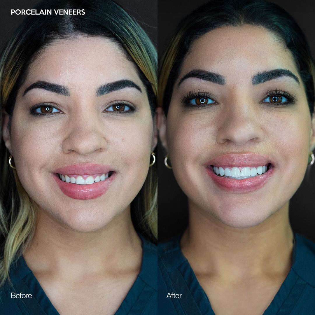 Custom porcelain veneers, full smile makeover, Svelta Dental Miami