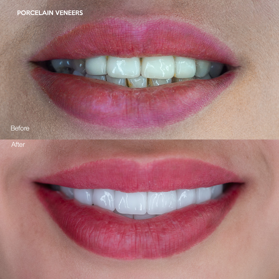 Porcelain veneers natural finish, Svelta Dental Design